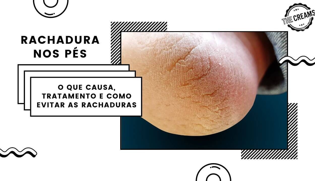 Rachadura nos Pés O que Causa Tratamento e Como Evitar as Rachaduras