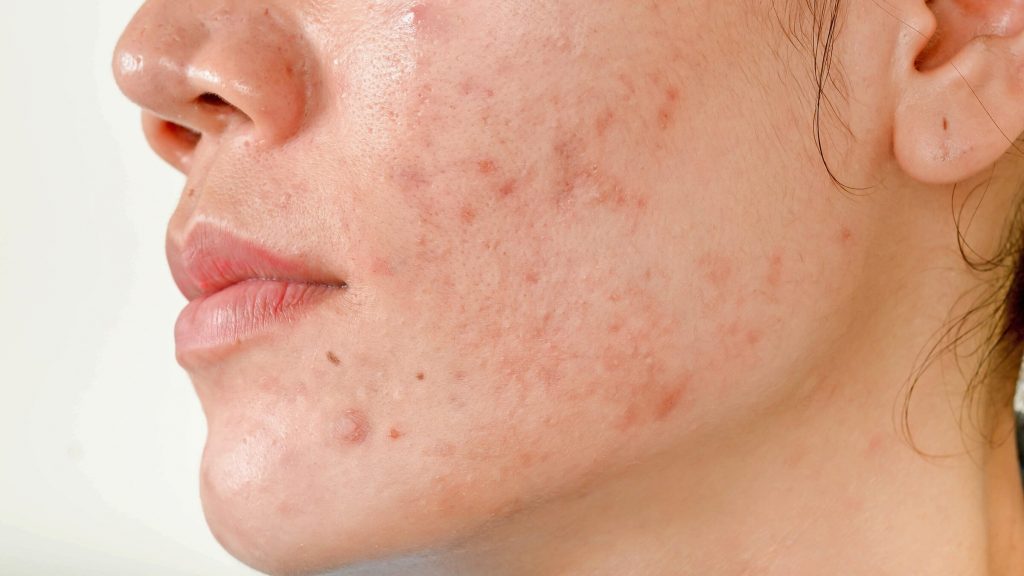 Guia Completo Cicatriz De Acne Como Preveni Las Causas E Tratamento The Creams Blog